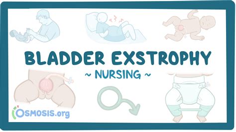 Bladder exstrophy